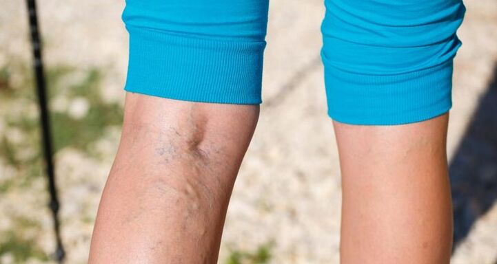 Vene varicose sulle gambe
