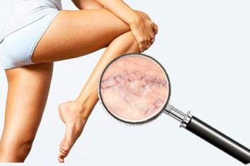 Varicosi delle gambe