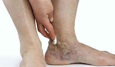 manifestazioni di vene varicose sulle gambe