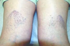 Vene varicose sulle gambe nella prima fase delle vene varicose