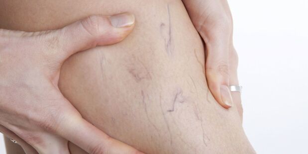 Vene varicose sulle gambe