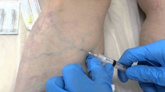 scleroterapia per le vene varicose sulle gambe nelle donne