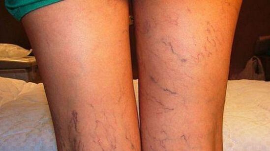 vene delle gambe con vene varicose