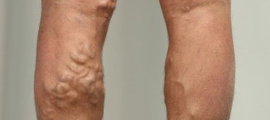 vene varicose sulla gamba