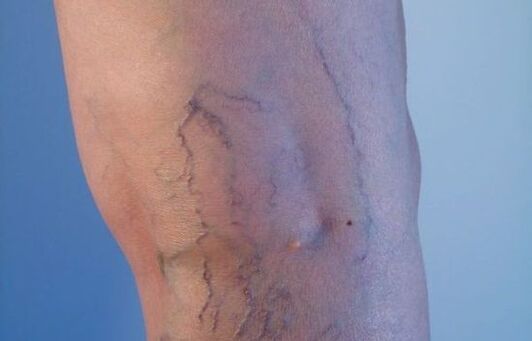 vene varicose sulle gambe nelle donne