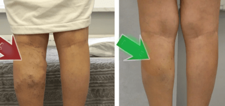 risultati del trattamento delle vene varicose sulle gambe