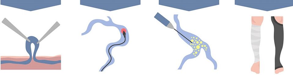 tipi di trattamento per le vene varicose