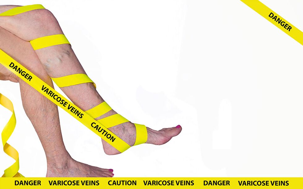 vene varicose sulle gambe