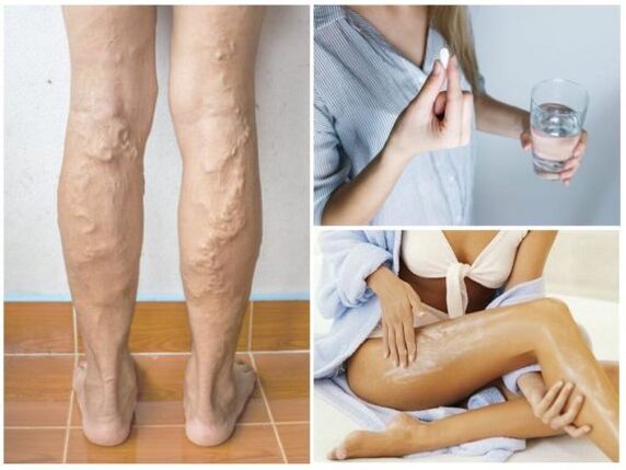 Metodi di trattamento per le vene varicose sulle gambe