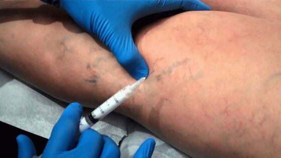 Scleroterapia per vene varicose
