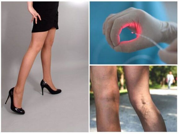 Trattamento laser delle vene varicose sulle gambe