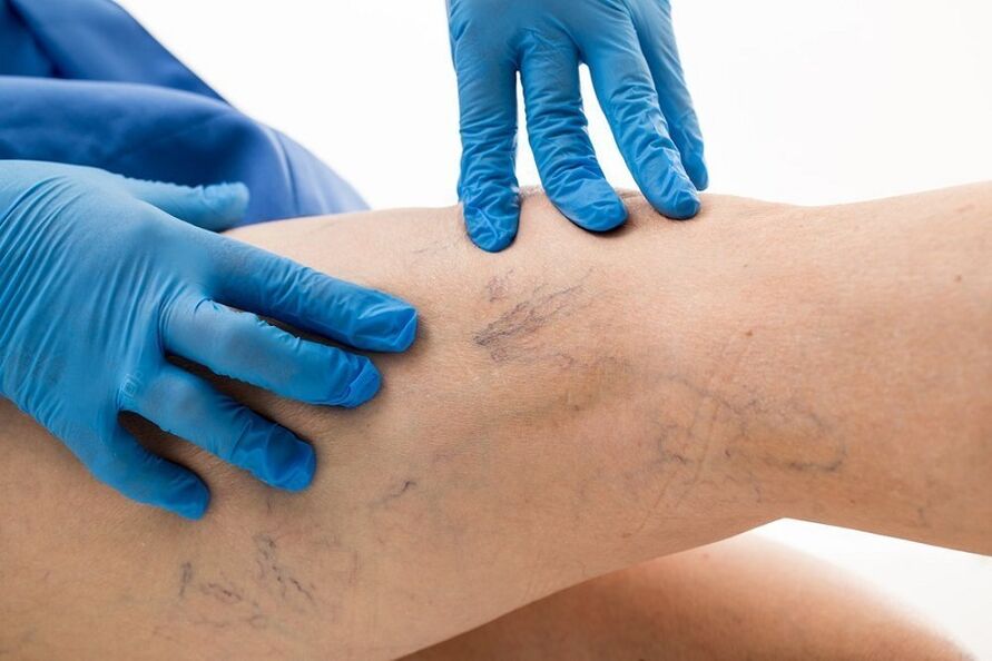 esame delle gambe per le vene varicose