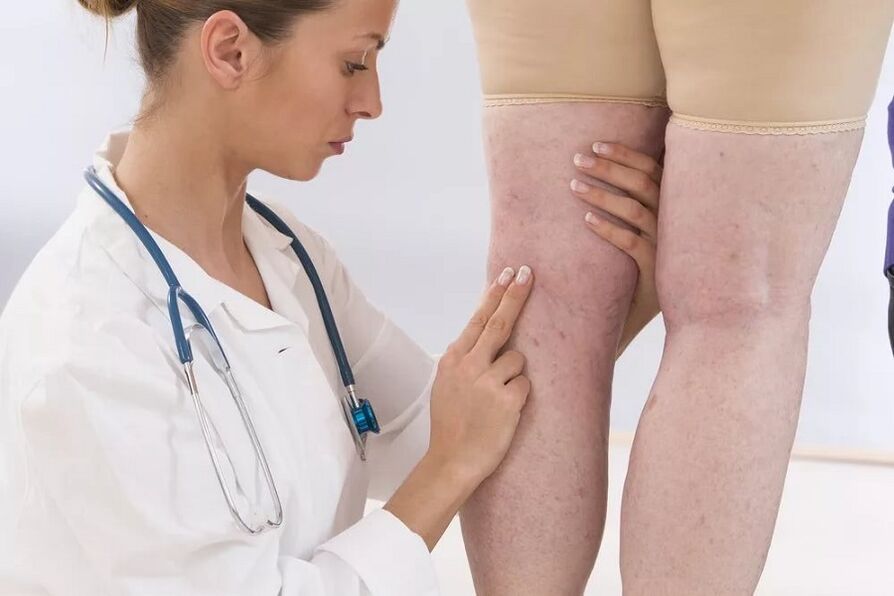 il medico esamina le vene per le vene varicose