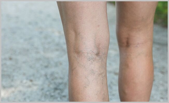 vene sporgenti delle gambe con vene varicose