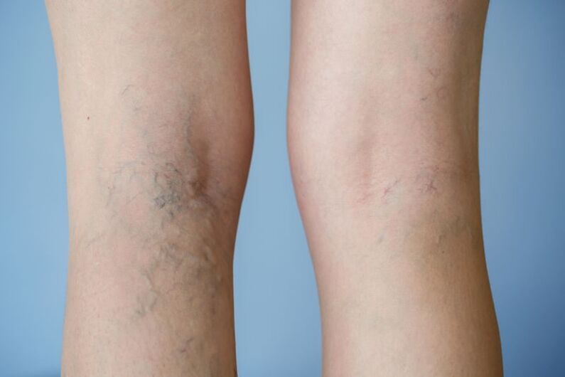 foto di vene varicose sulle gambe