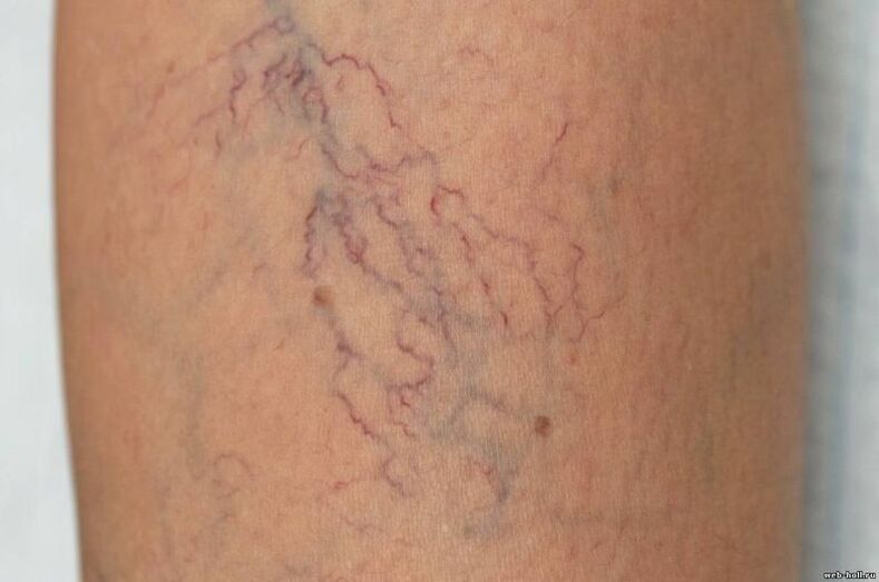 sintomi di vene varicose sulle gambe