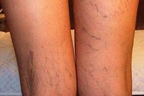 foto di vene varicose sulle gambe